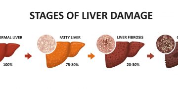 Neues Medikament Resmetirom gegen nichtalkoholische Steatohepatitis