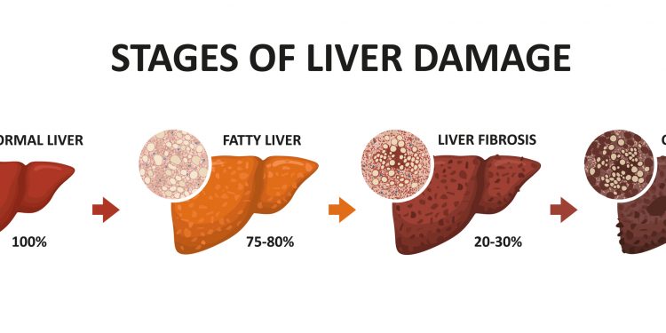 Neues Medikament Resmetirom gegen nichtalkoholische Steatohepatitis