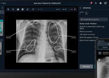 Qure.ai verfolgt große KI mit einer Serie-D-Finanzierung in Höhe von 65 Millionen US-Greenback und weiteren Aufträgen