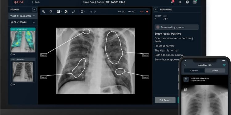 Qure.ai verfolgt große KI mit einer Serie-D-Finanzierung in Höhe von 65 Millionen US-Greenback und weiteren Aufträgen