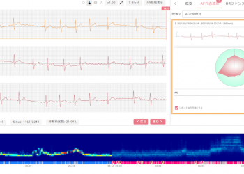 Nutzung „erklärbarer KI“ zur Bekämpfung des wachsenden Schlaganfallrisikos in Japan