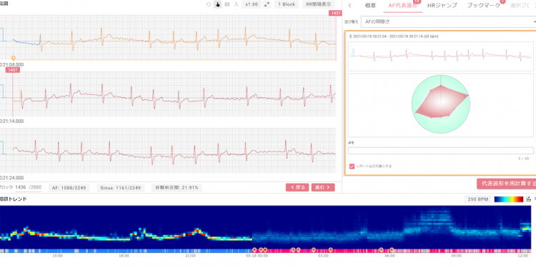 Nutzung „erklärbarer KI“ zur Bekämpfung des wachsenden Schlaganfallrisikos in Japan