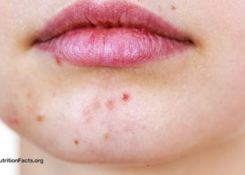 Akne und Vitamin B12