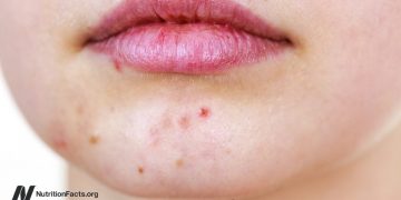 Akne und Vitamin B12