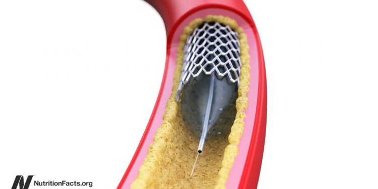 Warum sind Angioplastik -Herzstents nicht effektiver?