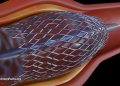 Herzstents und ihre Risiken