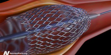 Herzstents und ihre Risiken