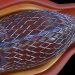 Herzstents und ihre Risiken