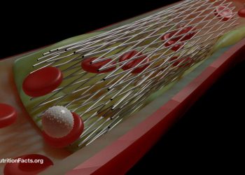 Nehmen Sie Herzstents an Angina -Brustschmerzen?