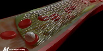 Nehmen Sie Herzstents an Angina -Brustschmerzen?