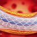 Warum Stents verwenden, wenn sie nicht arbeiten?