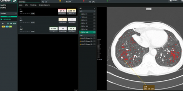 Coreline Gentle Scores Imaging AI Provide Contracts mit UK NHS, Boehringer Ingelheim und weiteren Briefs