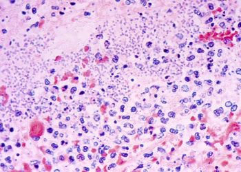 Was zu wissen, was man über die Pneumonische Pest nach Arizona Tod