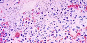 Was zu wissen, was man über die Pneumonische Pest nach Arizona Tod