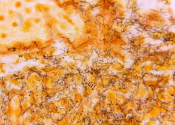 Warum Syphilis Fälle bei Neugeborenen steigen