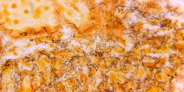 Warum Syphilis Fälle bei Neugeborenen steigen