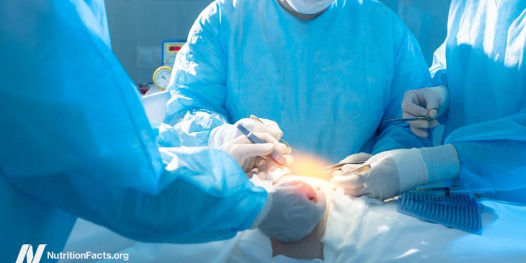 Bariatrische Gewichtsverlustchirurgie und Mortalität