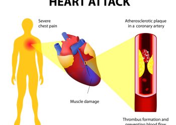 Eine moderne Geschichte der Diät-Herz-Hypothese