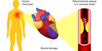 Eine moderne Geschichte der Diät-Herz-Hypothese