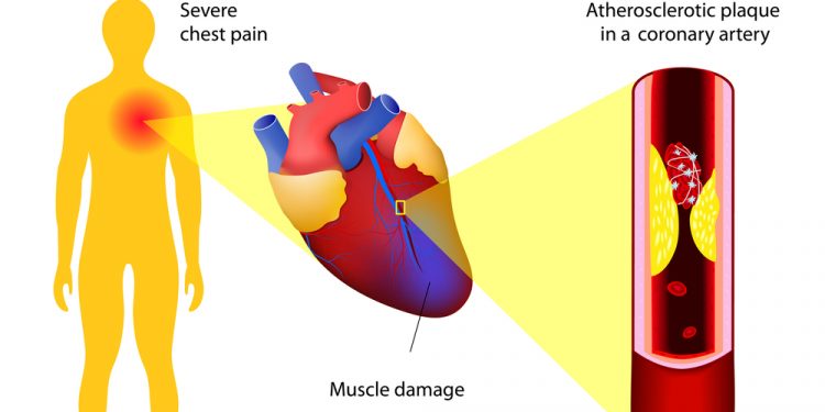 Eine moderne Geschichte der Diät-Herz-Hypothese