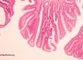 Könnte das Rinderleukämievirus eine Ursache für Brustkrebs sein?