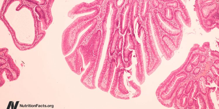Könnte das Rinderleukämievirus eine Ursache für Brustkrebs sein?