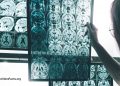 Ein persistentes Pestizid ist mit dem Alzheimer-Risiko verbunden